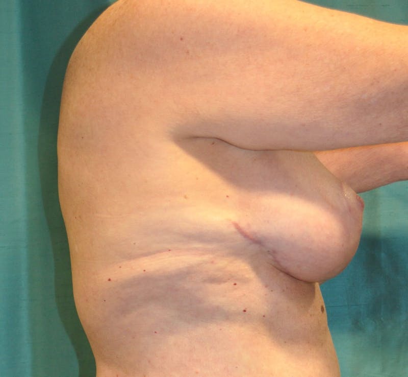 Breast Lift (Mastopexy) Before & After Gallery - Patient 90427223 - Image 4