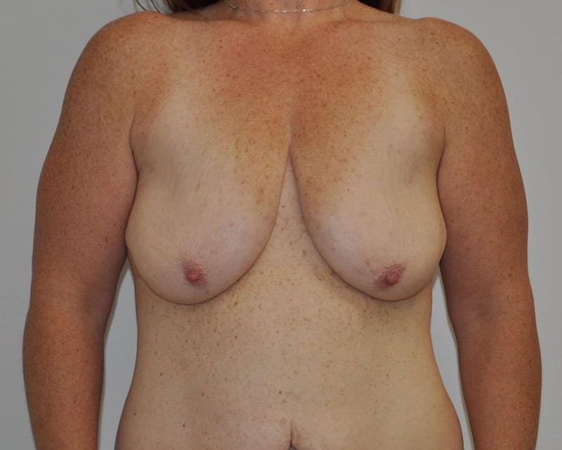 Breast Lift (Mastopexy) Before & After Gallery - Patient 90427237 - Image 1