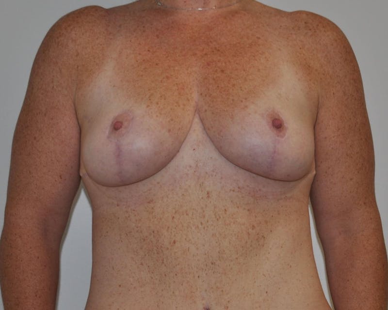 Breast Lift (Mastopexy) Before & After Gallery - Patient 90427237 - Image 2