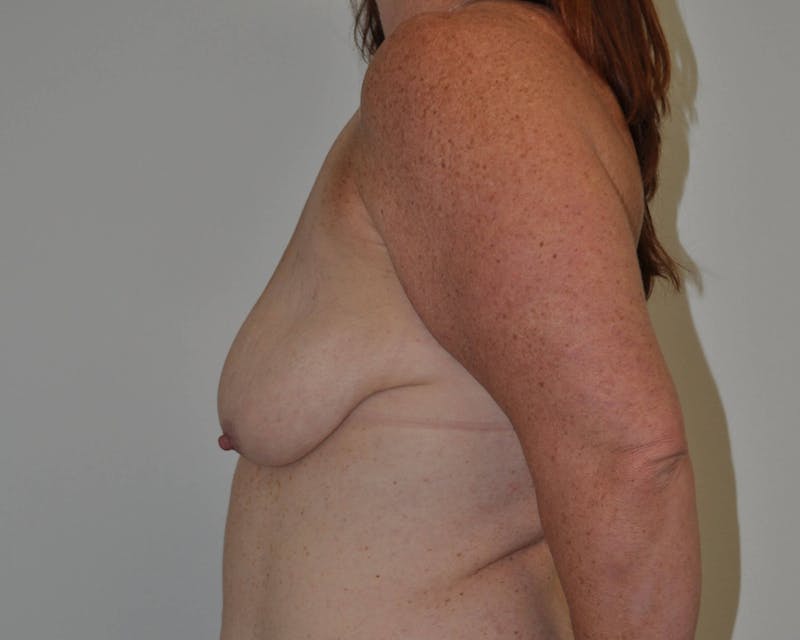 Breast Lift (Mastopexy) Before & After Gallery - Patient 90427237 - Image 5