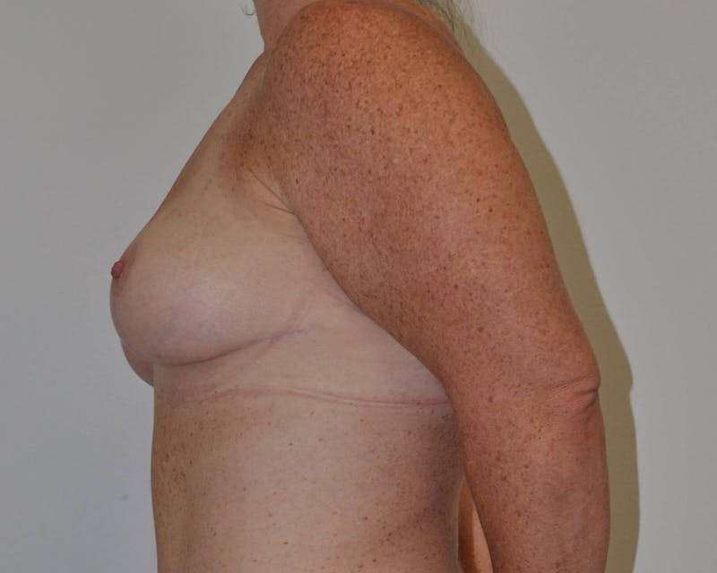 Breast Lift (Mastopexy) Gallery - Patient 90427237 - Image 6