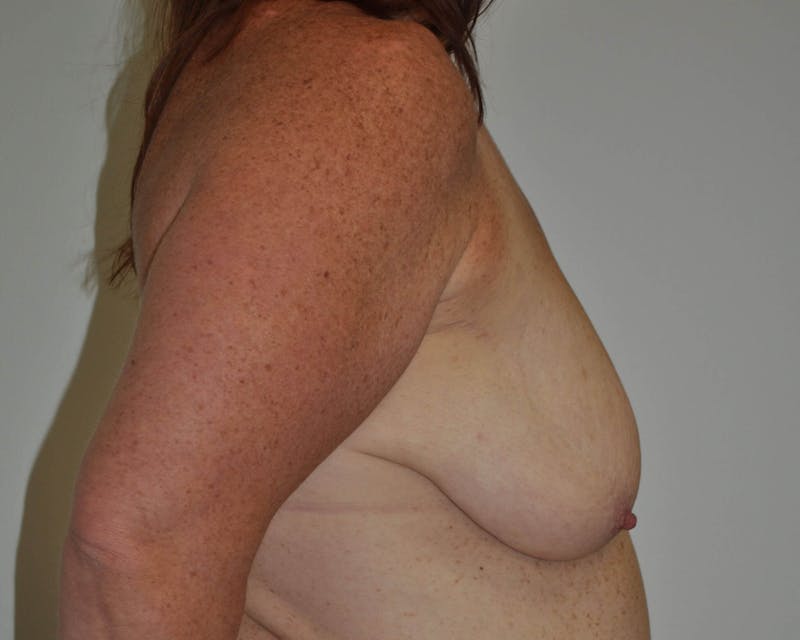 Breast Lift (Mastopexy) Before & After Gallery - Patient 90427237 - Image 9
