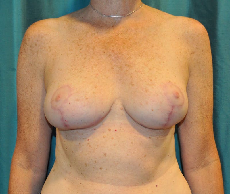 Breast Lift (Mastopexy) Before & After Gallery - Patient 90427248 - Image 2