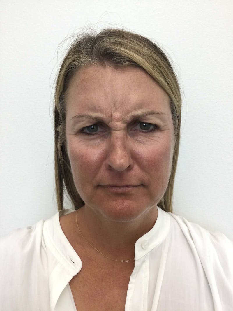 BOTOX® Before & After Gallery - Patient 90429613 - Image 5