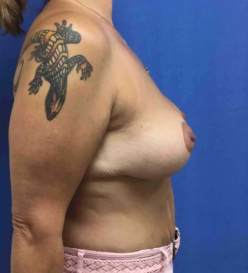 Breast Lift (Mastopexy) Before & After Gallery - Patient 90429715 - Image 4