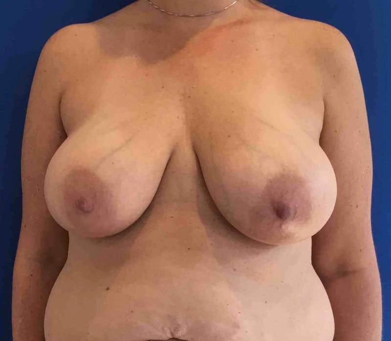 Breast Lift (Mastopexy) Before & After Gallery - Patient 90429865 - Image 1