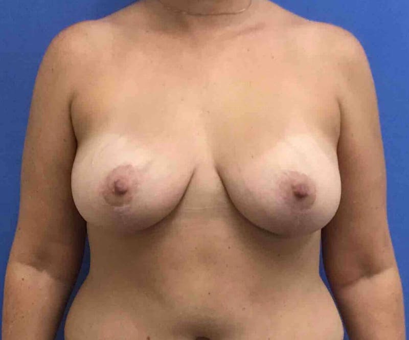 Breast Lift (Mastopexy) Before & After Gallery - Patient 90429865 - Image 2