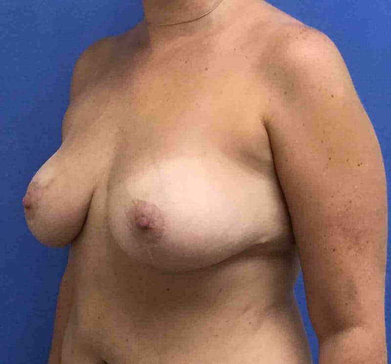 Breast Lift (Mastopexy) Before & After Gallery - Patient 90429865 - Image 4