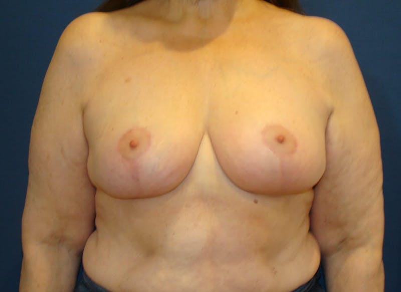 Breast Lift (Mastopexy) Before & After Gallery - Patient 90430210 - Image 2