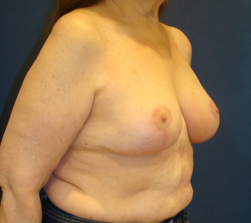 Breast Lift (Mastopexy) Before & After Gallery - Patient 90430210 - Image 4