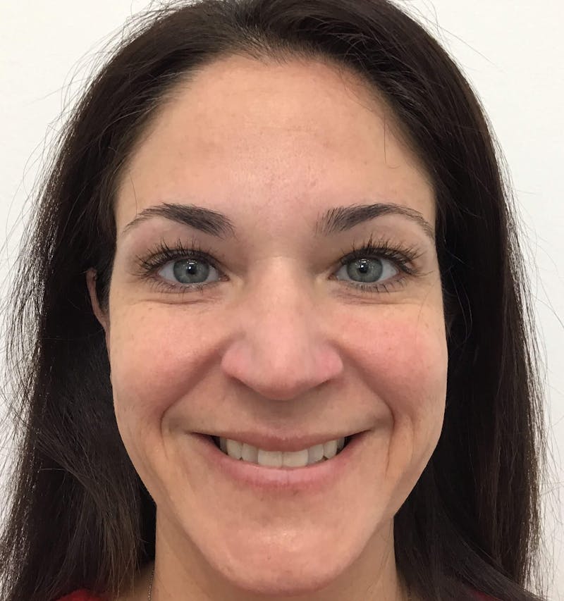 BOTOX® Before & After Gallery - Patient 90430343 - Image 4