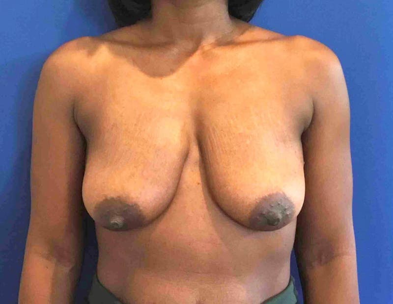 Breast Lift (Mastopexy) Before & After Gallery - Patient 90430491 - Image 1