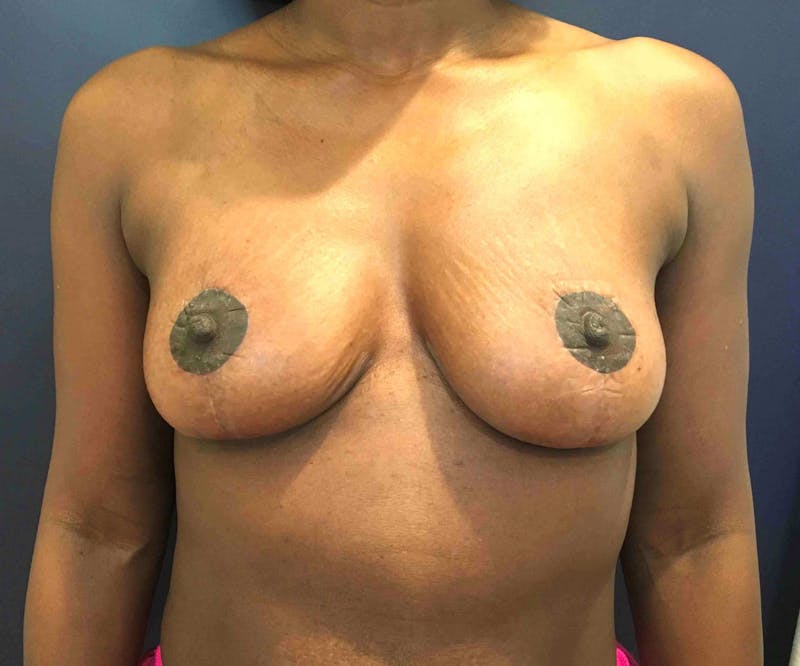 Breast Lift (Mastopexy) Before & After Gallery - Patient 90430491 - Image 2