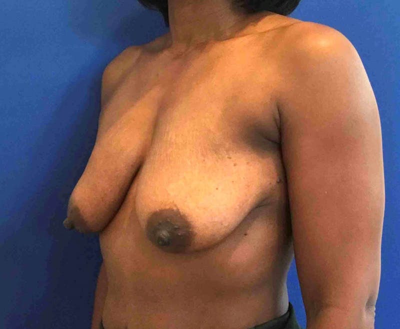 Breast Lift (Mastopexy) Before & After Gallery - Patient 90430491 - Image 3