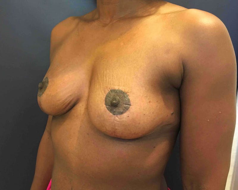 Breast Lift (Mastopexy) Before & After Gallery - Patient 90430491 - Image 4