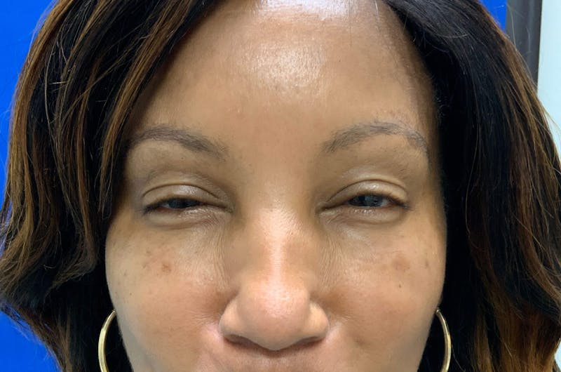 BOTOX® Before & After Gallery - Patient 90430570 - Image 2