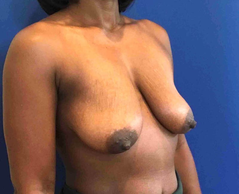 Breast Lift (Mastopexy) Before & After Gallery - Patient 90430491 - Image 5