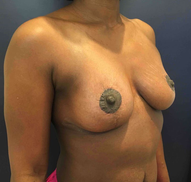 Breast Lift (Mastopexy) Before & After Gallery - Patient 90430491 - Image 6