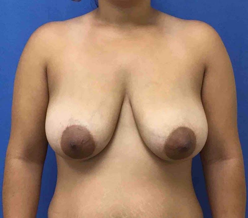 Breast Lift (Mastopexy) Before & After Gallery - Patient 90430731 - Image 1