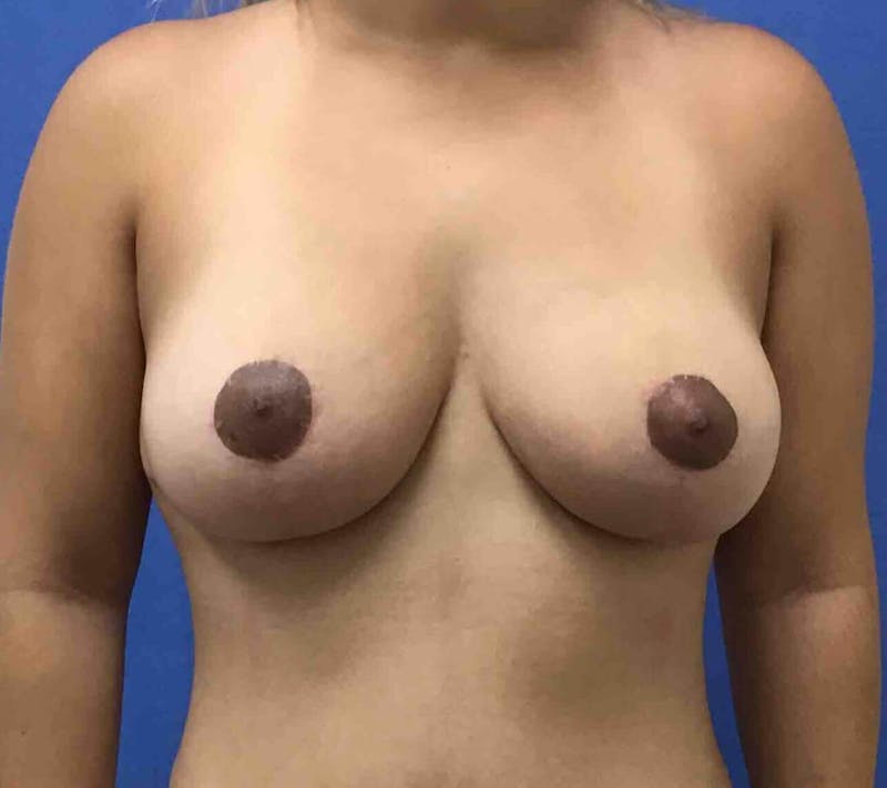 Breast Lift (Mastopexy) Before & After Gallery - Patient 90430731 - Image 2
