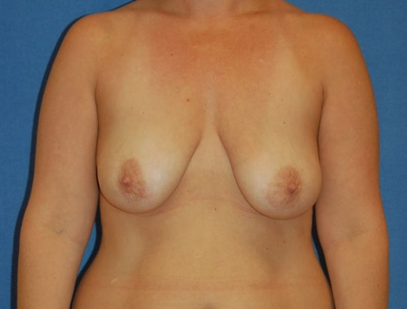 Breast Lift (Mastopexy) Before & After Gallery - Patient 90430896 - Image 1