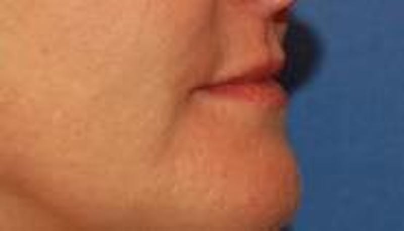 BOTOX® Before & After Gallery - Patient 90431034 - Image 3