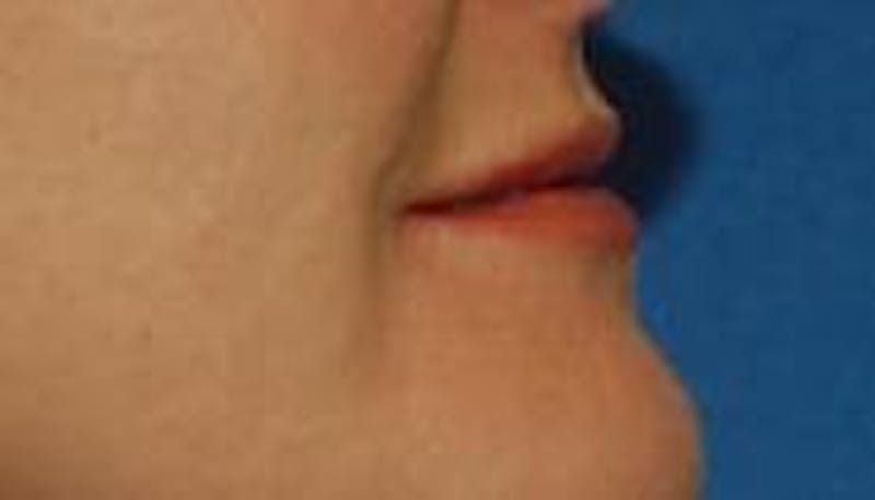 BOTOX® Before & After Gallery - Patient 90431034 - Image 4
