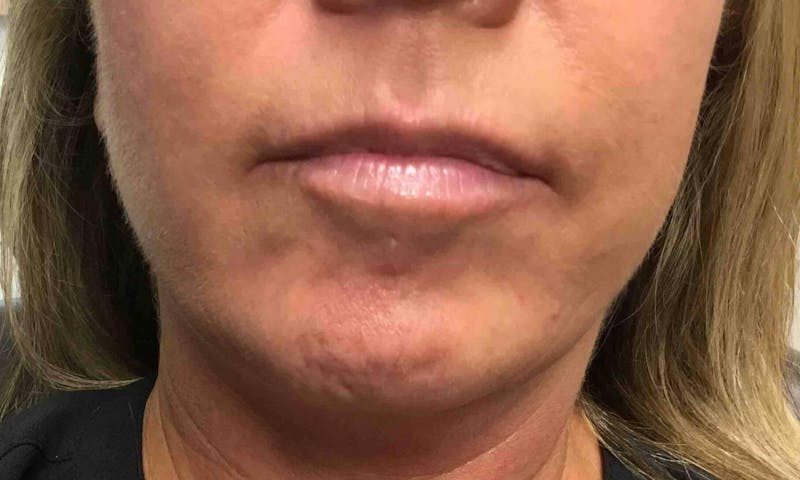 BOTOX® Before & After Gallery - Patient 90431042 - Image 1