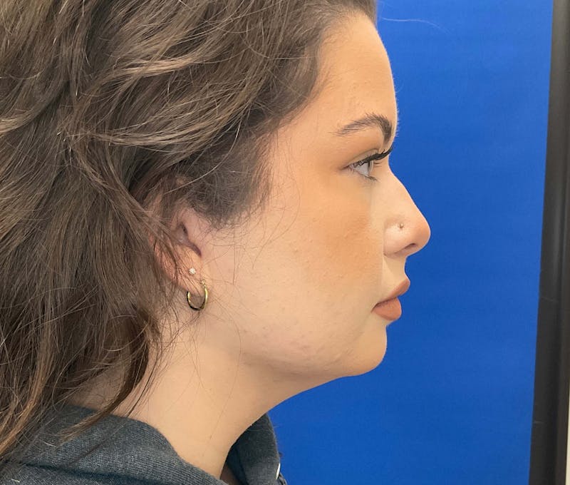 Kybella® Before & After Gallery - Patient 90431103 - Image 4