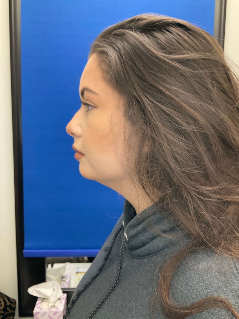 Kybella® Before & After Gallery - Patient 90431103 - Image 6