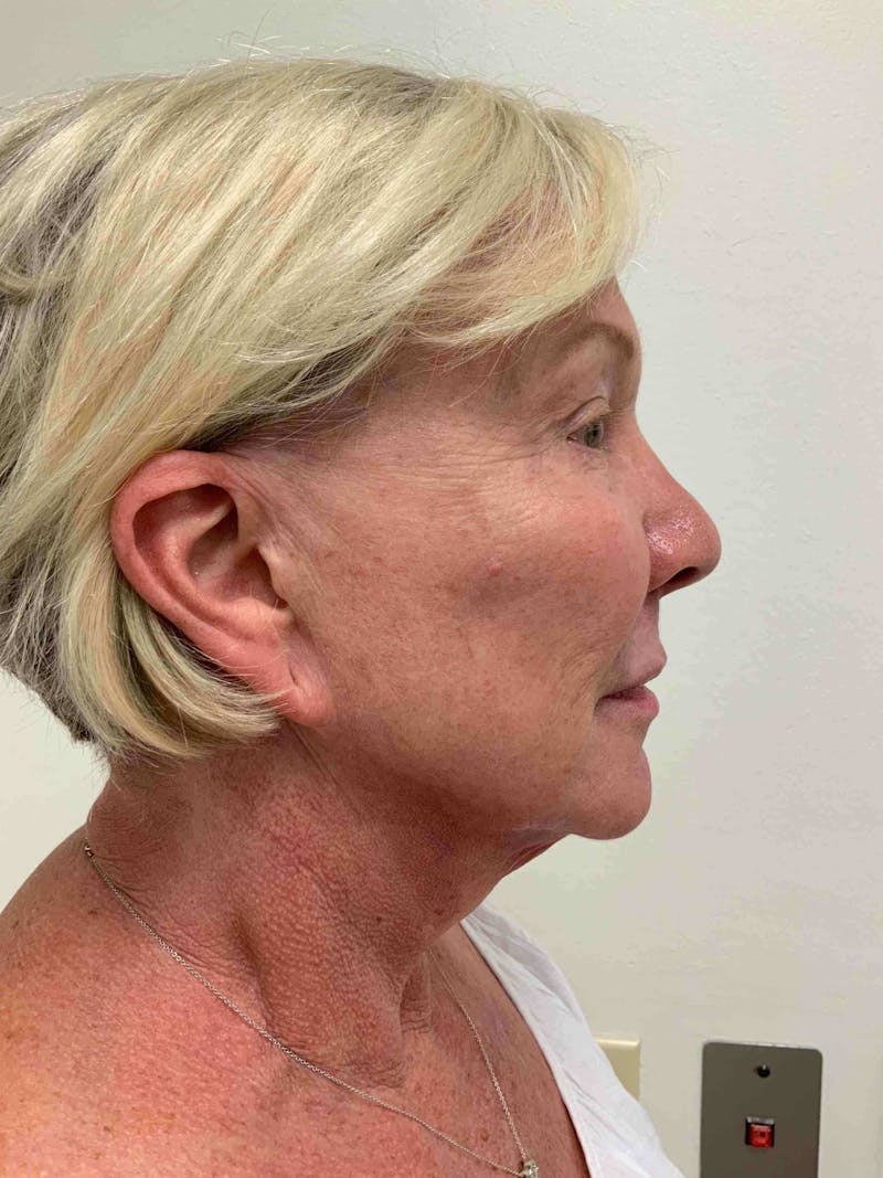 Kybella® Before & After Gallery - Patient 90431112 - Image 4