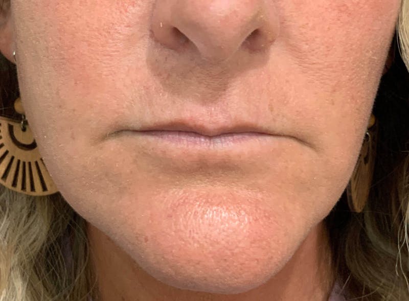 Juvéderm® Before & After Gallery - Patient 90432889 - Image 1