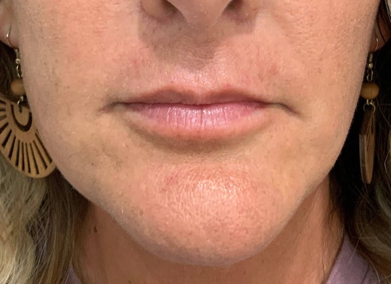Juvéderm® Before & After Gallery - Patient 90432889 - Image 2