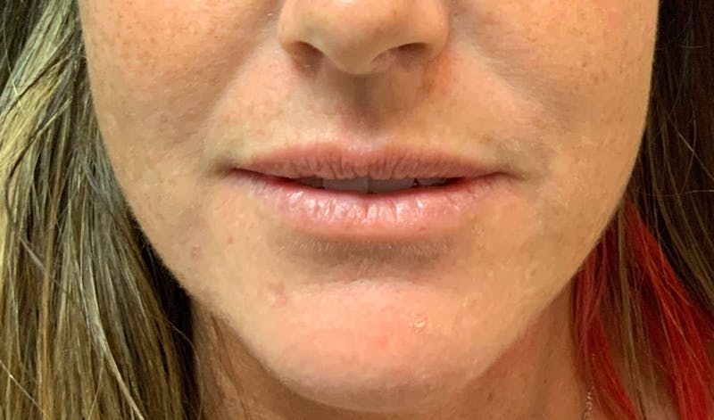 Juvéderm® Before & After Gallery - Patient 90432891 - Image 1
