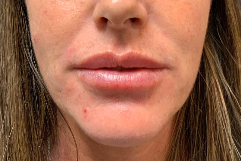 Juvéderm® Before & After Gallery - Patient 90432891 - Image 2