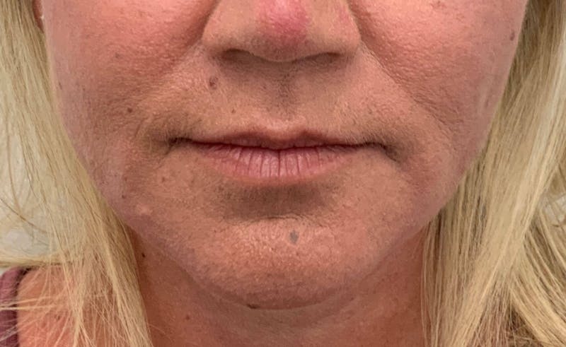 Juvéderm® Before & After Gallery - Patient 90432911 - Image 1