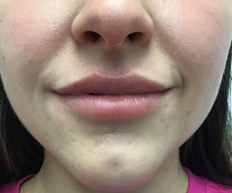 Juvéderm® Before & After Gallery - Patient 90433222 - Image 2