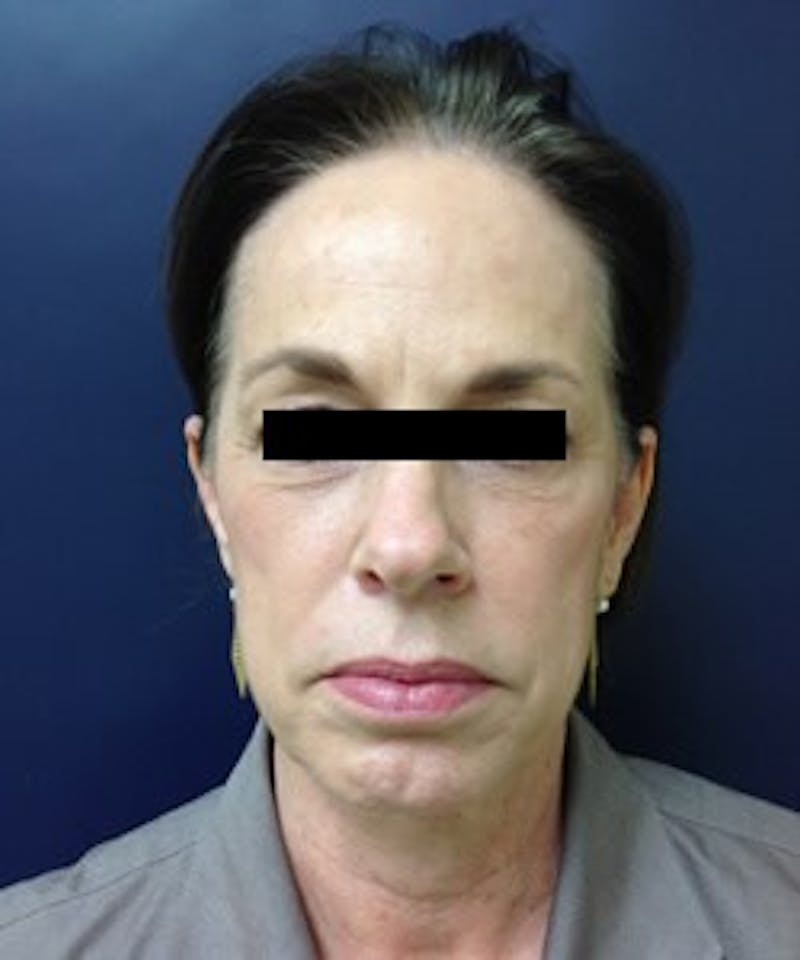 Juvéderm® Before & After Gallery - Patient 90433712 - Image 1