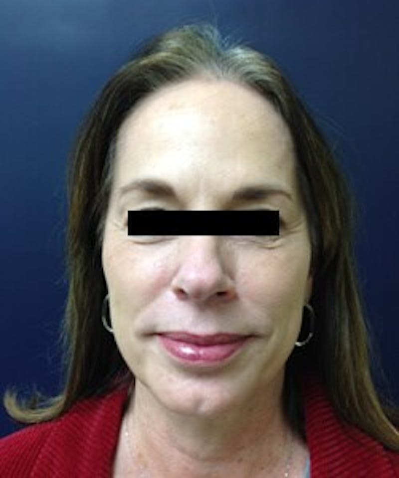Juvéderm® Before & After Gallery - Patient 90433712 - Image 2