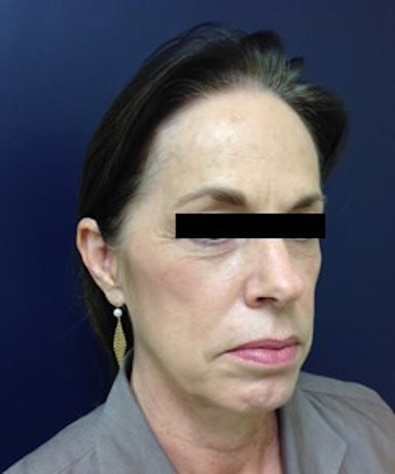 Juvéderm® Before & After Gallery - Patient 90433712 - Image 3