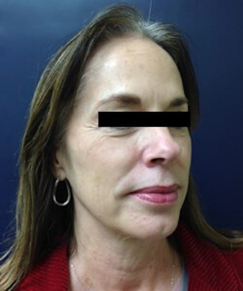 Juvéderm® Before & After Gallery - Patient 90433712 - Image 4