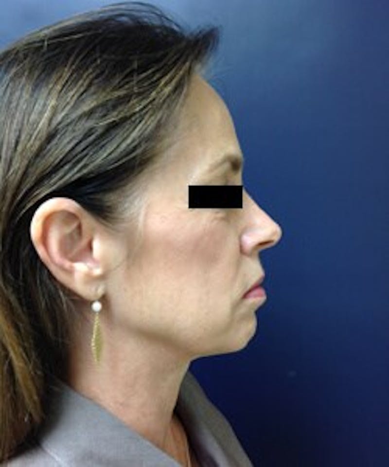 Juvéderm® Before & After Gallery - Patient 90433712 - Image 5