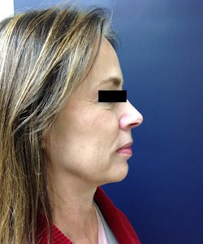 Juvéderm® Before & After Gallery - Patient 90433712 - Image 6