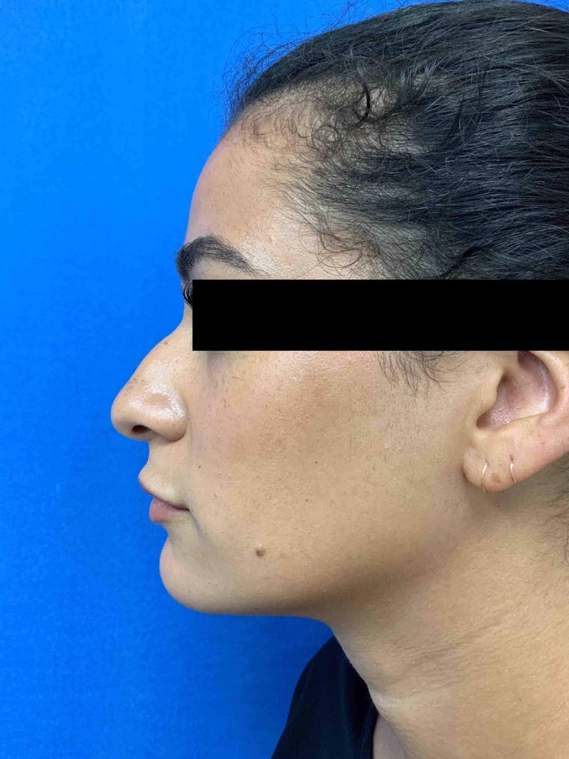 Juvéderm® Before & After Gallery - Patient 90434051 - Image 1