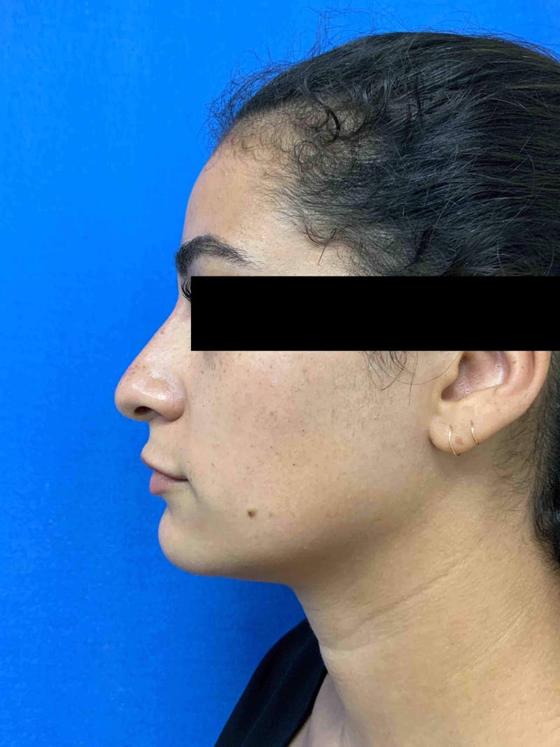 Juvéderm® Before & After Gallery - Patient 90434051 - Image 2