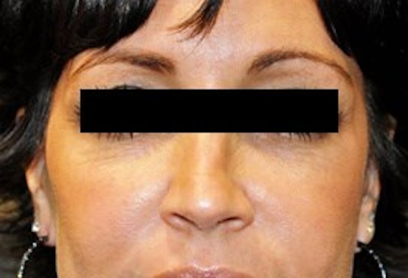 Voluma® Before & After Gallery - Patient 90434456 - Image 1