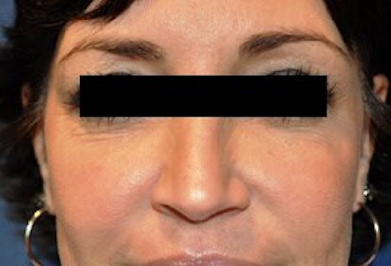Voluma® Before & After Gallery - Patient 90434456 - Image 2