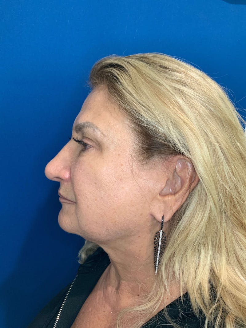BBL™ Laser Before & After Gallery - Patient 90436618 - Image 4