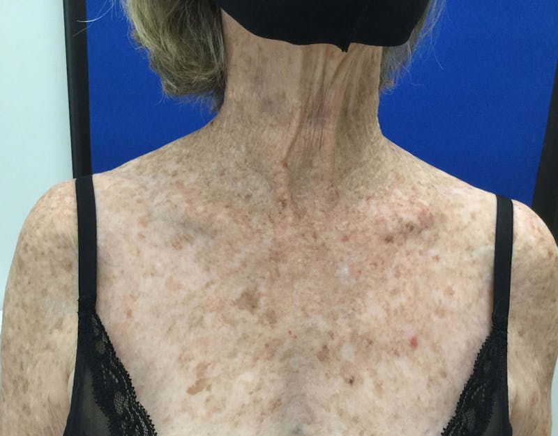 BBL™ Laser Before & After Gallery - Patient 90436658 - Image 2