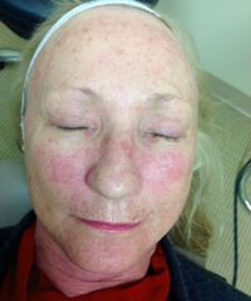 BBL™ Laser Before & After Gallery - Patient 90436670 - Image 1